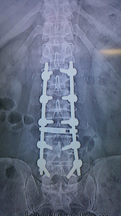 Omurilik Kanal Daralması Tedavisi
