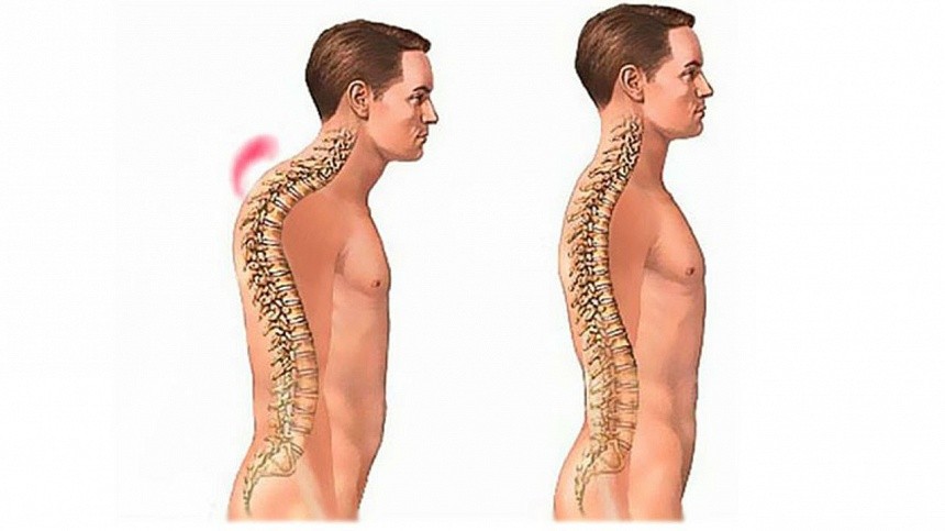 Kifoz ve Cerrahi Tedavisi